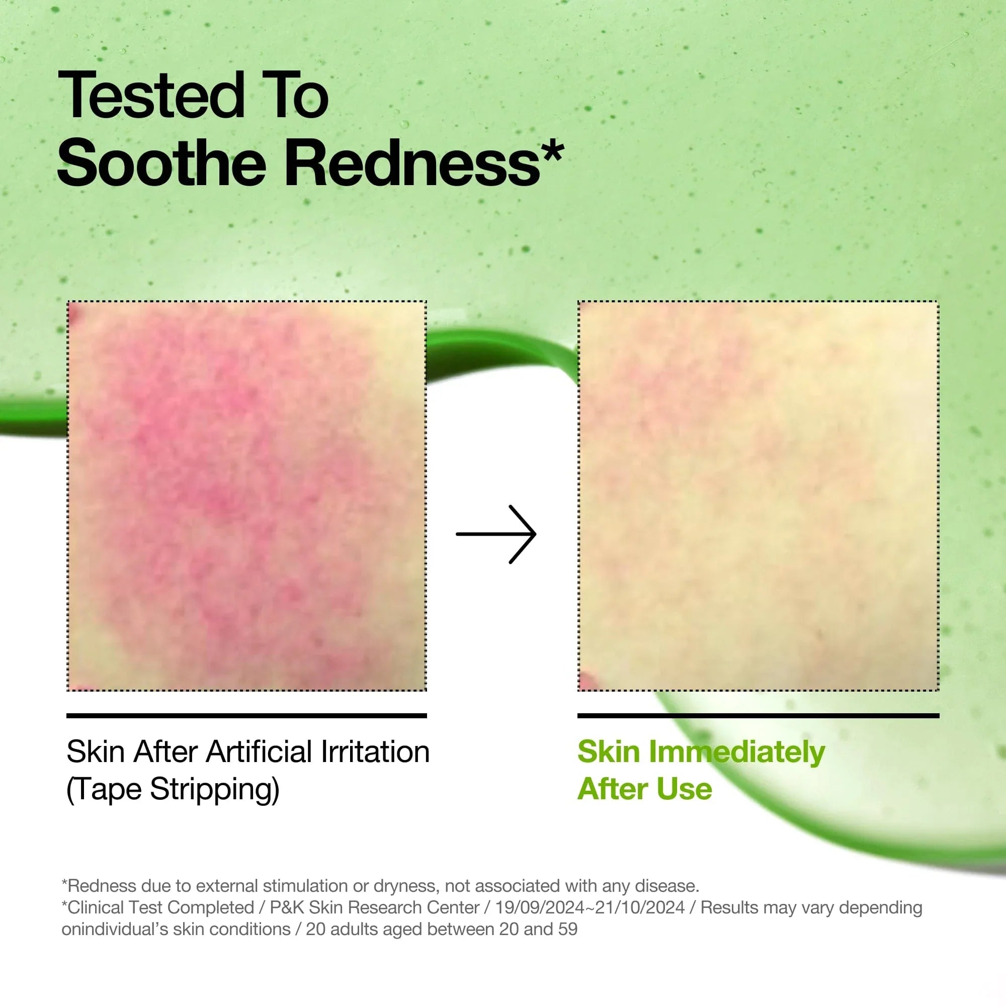 Anua Azelaic Acid 10 Hyaluron Redness Soothing Serum (30ml / 1.01 fl. oz.) | K-Beauty Blemish & Redness Relief Serum
